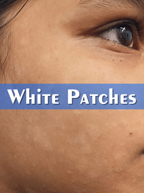 White Patch